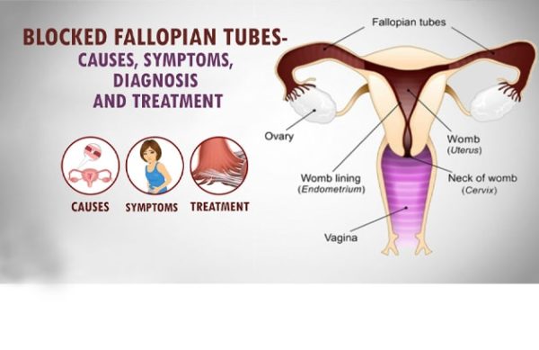 Fallopian Tube Blockage Treatment Without Surgery - Dr Chanchal Sharma