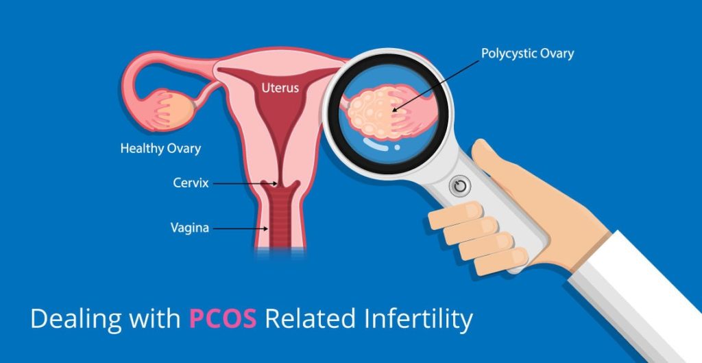 PCOS/PCOD Dr Chanchal Sharma