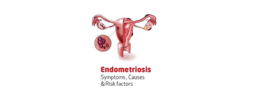 Risk factors of endometriosis