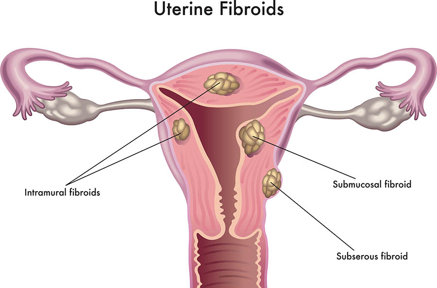 uterine-fibroids-diagnosis-and-treatment-dr-chanchal-sharma