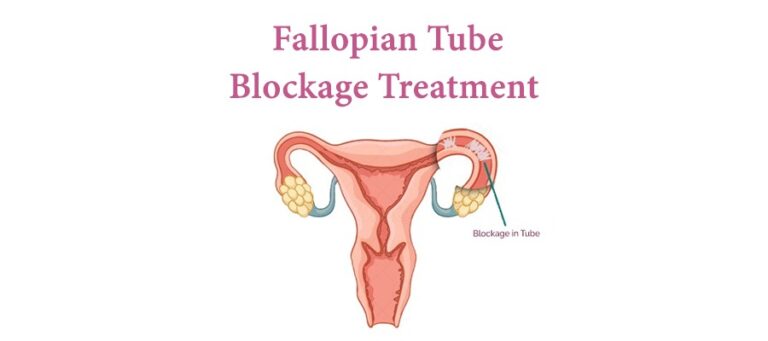 treatment-for-blocked-fallopian-tubes-symptoms-and-fertility