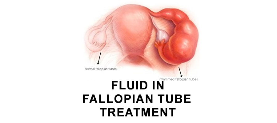 fluid-in-fallopian-tube-treatment-symptoms-and-diagnosis