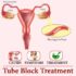 tube block treatment, fallopian tube blockage